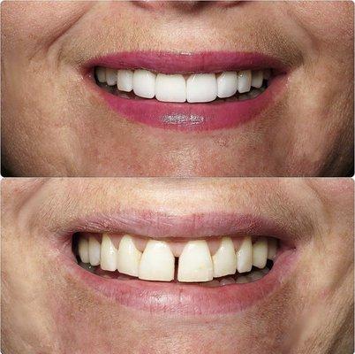 Before and After result of one of our happy patients