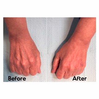 Don't let your hands give away your age...Voluma injections