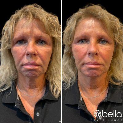 Fillers and Botox for this sweet lady. "I love it!"