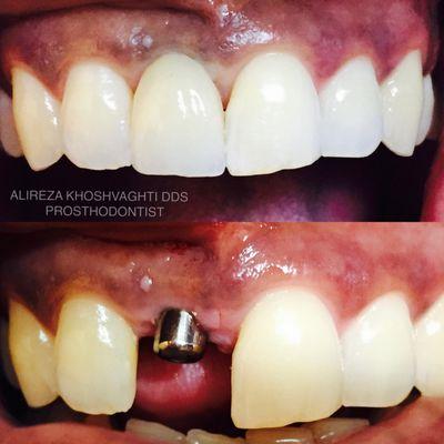 Implant-supported crown replacing upper front tooth