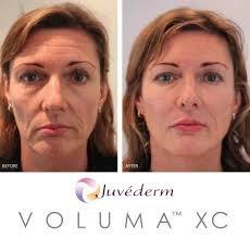 Voluma Before and After