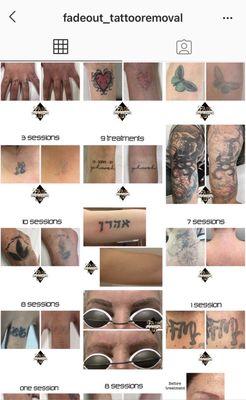 Fade Out Tattoo Removal