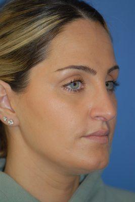 Post op rhinoplasty to reduce bump and refine tip