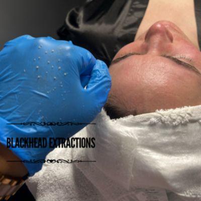 Blackhead extractions. Grt your facial today.