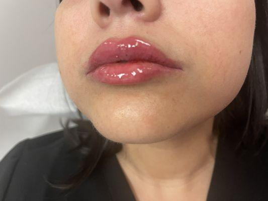 My beautiful new lips!