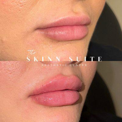 Lip Filler Before and After