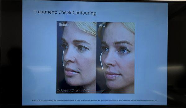 Check Contouring