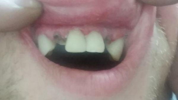 After cosmetic bonding and before a partial denture