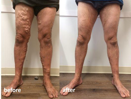 varicose veins removal
laser vein treatment