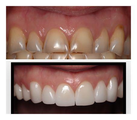 Veneers before and after