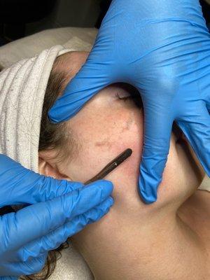 Dermaplaning.