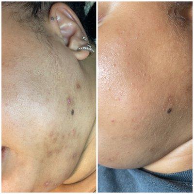 What 3 chemical peels and the right skin care regimen can do for you