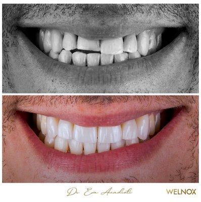 Veneers and Dental Implants.