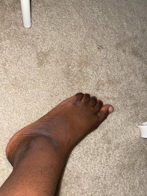 Yess ashy toes