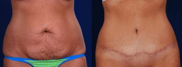 Tummy Tuck (Real Patient)