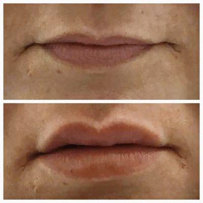 Restylane lip filler $375