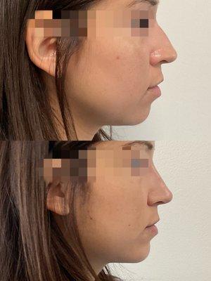 Nose & Chin Filler