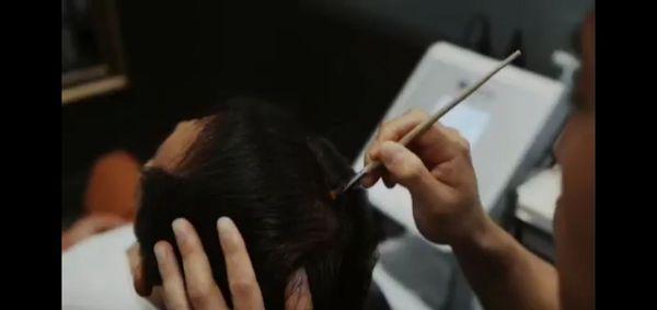 Personalized non surgical scalp treatments