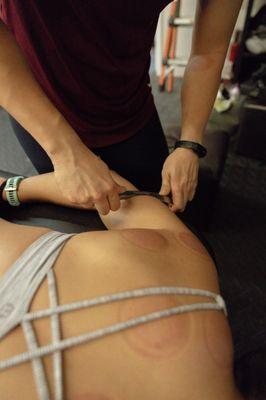 IASTM - Instrumental Assisted Soft Tissue Mobilization