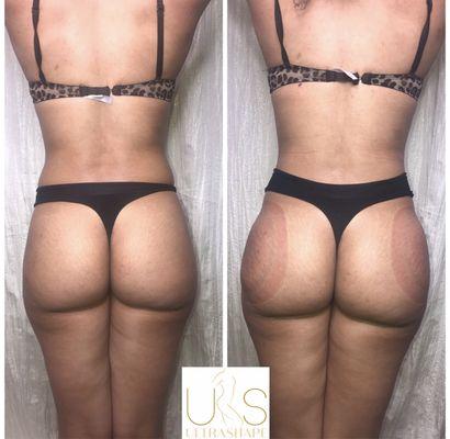 Booty lift/plump treatment