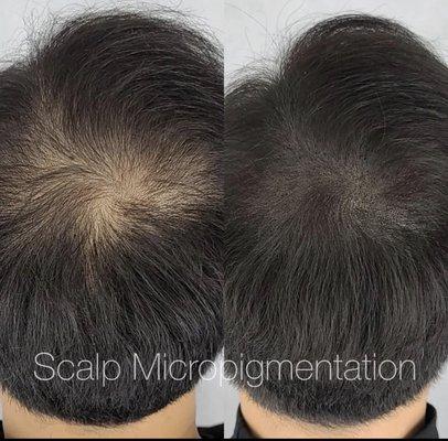 pigments are precisely applied to the scalp to replicate real hair follicles.