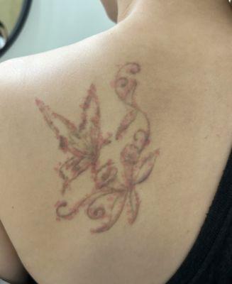 Removery Tattoo Removal & Fading