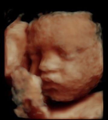 BabyVision Ultrasound