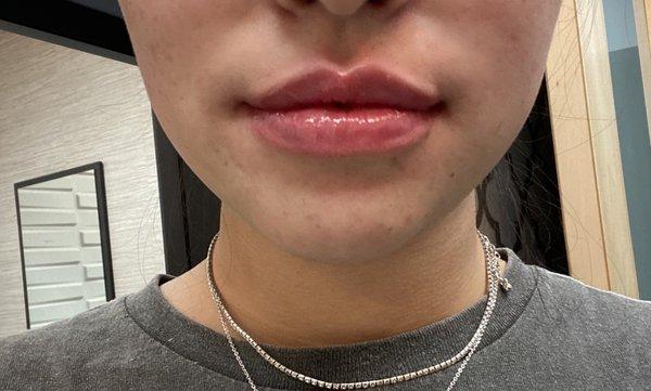 after lip filler