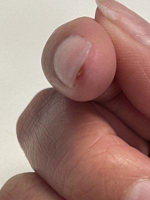 Cutting into my nail beds and causing an infection