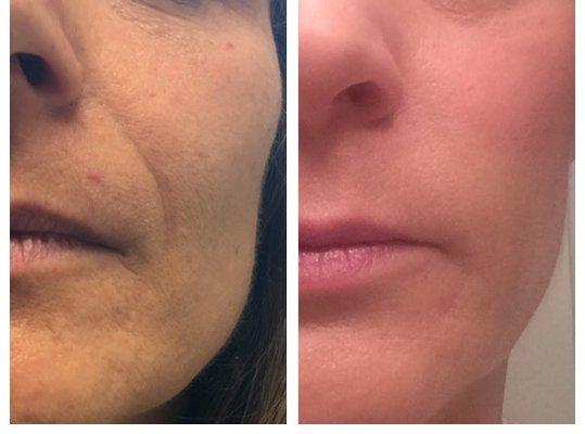 Dermal Filler  for smile lines  before and after!