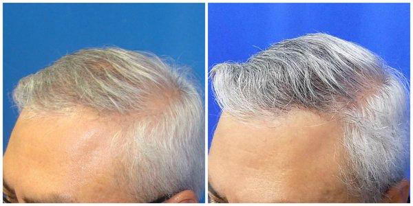 45-54 year old man treated with Hair Loss Treatment