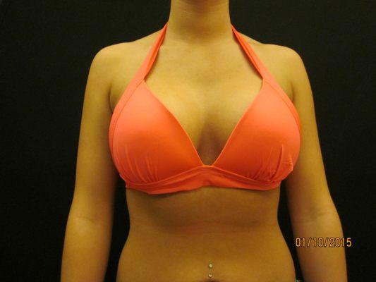 After Breast Augmentation