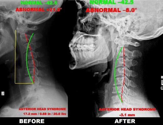 Before and After 3 months of Structural Correction for a Male Patient with Disc Herniations and Reduced Muscle Weakness and Atrophy