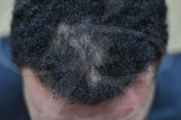 Before scalp micropigmentation