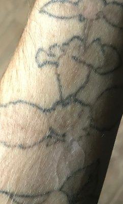 Hypo-pigmented scar from being burned from Belle Mia's laser. They deny burning my skin and blame me. Horrible customer service.