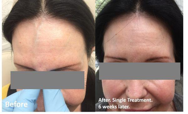 forehead vein treatment