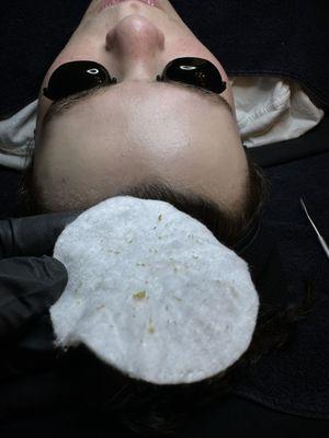 Extractions performed in Clarity Facial.