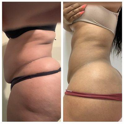 Progress photos of laser Lipo + Lipo Cavitation sessions