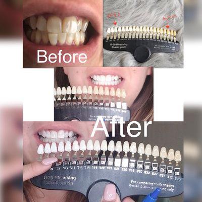 Teeth whitening restoration