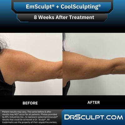 8 weeks after EmSculpt + CoolSculpting treatments on arms