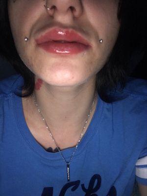 immediately after him doing my lips. swelling above is migration