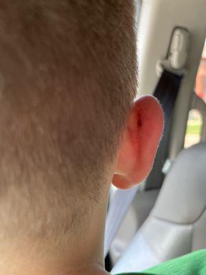 Bleeding ear after haircut.