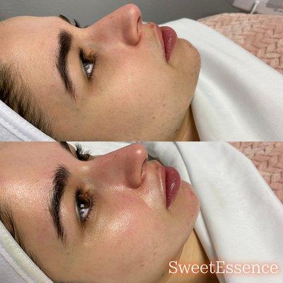 Dermaplane Facial 
Service - Bye bye peach fuzz.