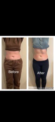 5 sessions of cryoslimming.