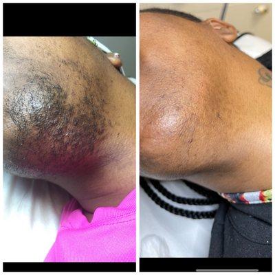 An other happy costumer!!!  Before and after electrolysis hair removal