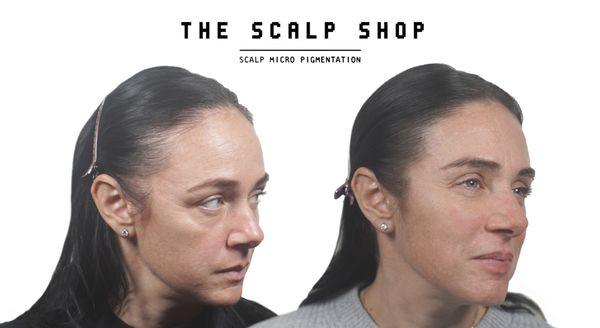 Kassy's Scalp Micropigmentation results. Women's hair loss at the Scalp Shop New York