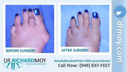 Bunion and hammertoe correction