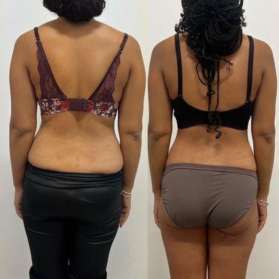 Body Mix Contouring before and after