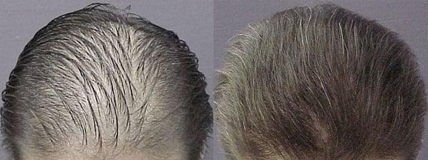 FUE Hair Restoration