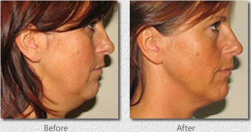 Viora Reaction for skin tightening.